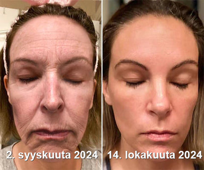 (💍Valmistettu ja lähetetty Kanadasta✅) 👩‍⚕️Furzero™ Botox-mehiläisen myrkkyrynkojenpoisto-kreemiksi - (VIIMEINEN PÄIVÄ 70% ALENNUSTA)
